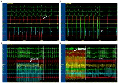 Blockade of Exosome Release Suppresses Atrial Fibrillation by Alleviating Atrial Fibrosis in Canines With Prolonged Atrial Pacing